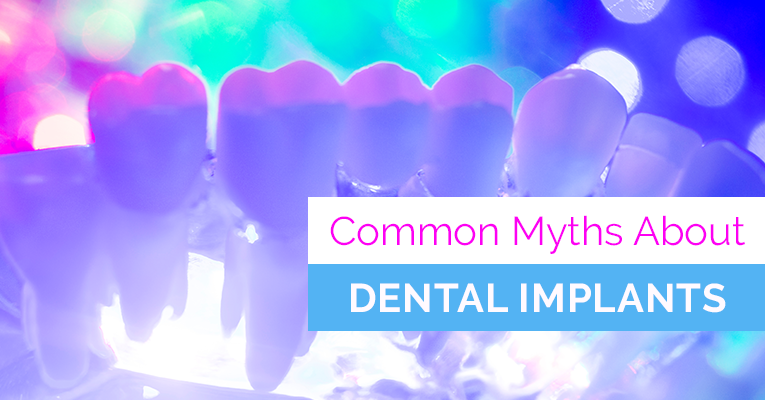 common myths about dental implants