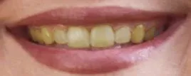 smile with yellow teeth