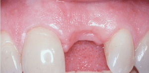 dental implant case study