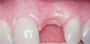 dental implant case study
