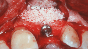 dental implant case study
