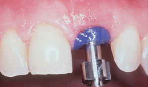 dental implant case study