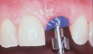 dental implant case study