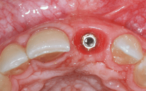 dental implant case study