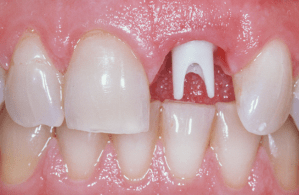 dental implant case study