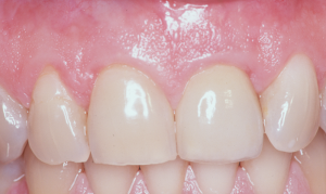 After dental implant placement