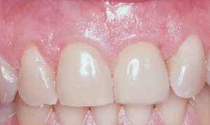 After dental implant placement