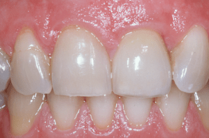After dental implant placement