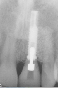Dental implant xray