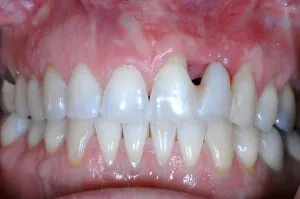 dental implant case study