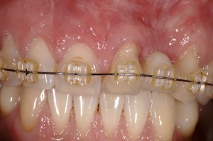 dental implant case study