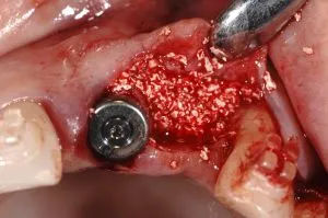 dental implant case study