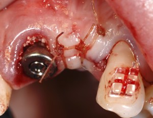 dental implant case study