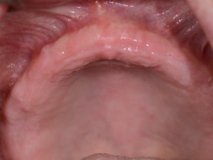 dental implant case study