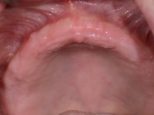 dental implant case study