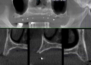 xray of a dental implant