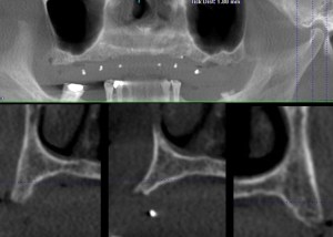 xray of a dental implant