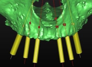 dental implant case study