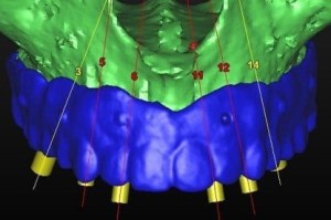 dental implant case study