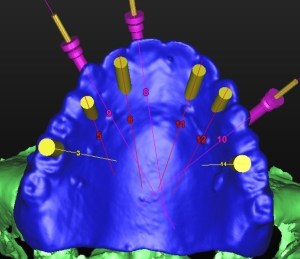 dental implant case study