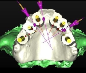 dental implant case study