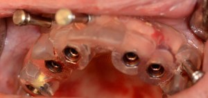 dental implant case study