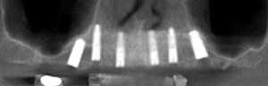 xray of dental implants