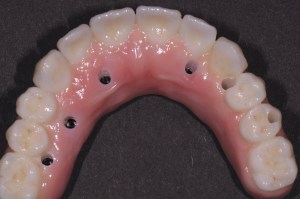 Denture