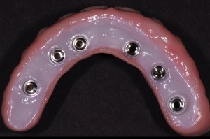 Denture