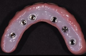 Denture