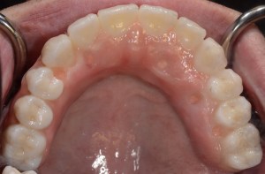After dental implants