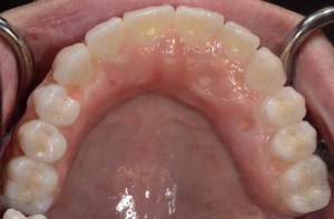 After dental implants