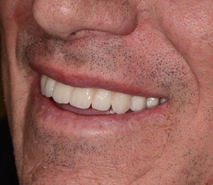 After dental implants