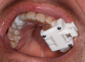 dental implant case study