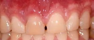 dental implant case study