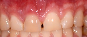 dental implant case study