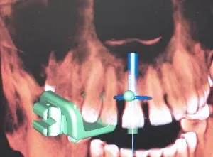 dental implant case study