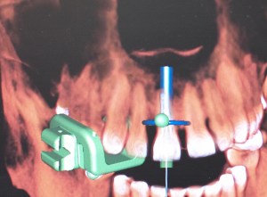 dental implant case study