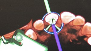 dental implant case study