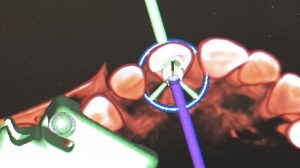 dental implant case study