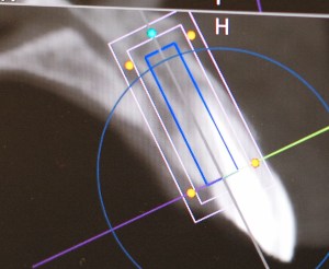 dental implant case study