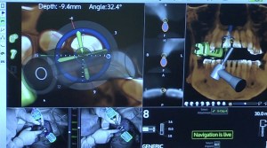 dental implant case study