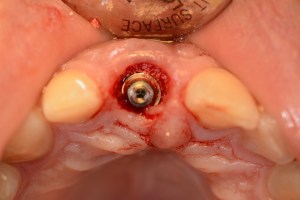 dental implant case study