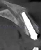 x-ray of a dental implant