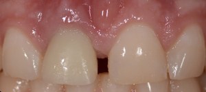 dental implant case study