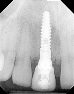 x-ray of a dental implant