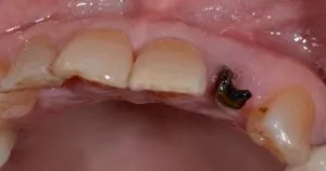 dental implant case study