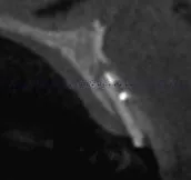 x-ray of a dental implant
