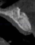 x-ray of a dental implant
