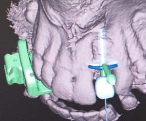 dental implant case study
